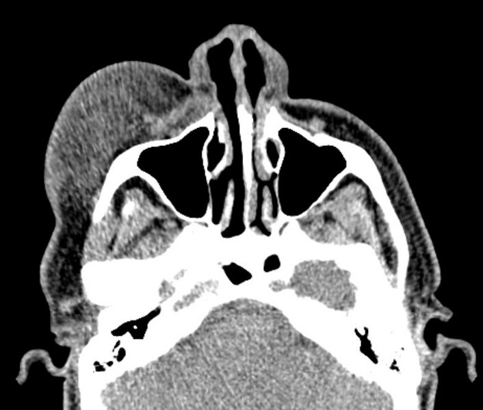 File:Necrobiotic xanthogranuloma- face (Radiopaedia 29549-30052 Axial C+ delayed 8).jpg
