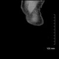 Neonatal neuroblastoma (Radiopaedia 56651-63438 Coronal non-contrast 49).jpg