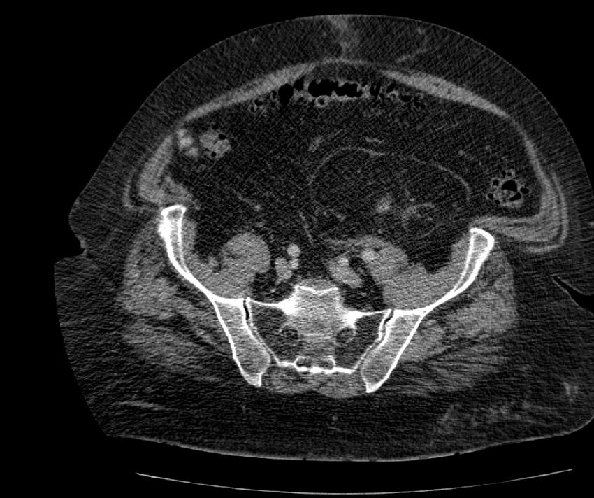 Nephroptosis with inguinal hernia containing perirenal fat (Radiopaedia 56632-63391 C 260).jpg