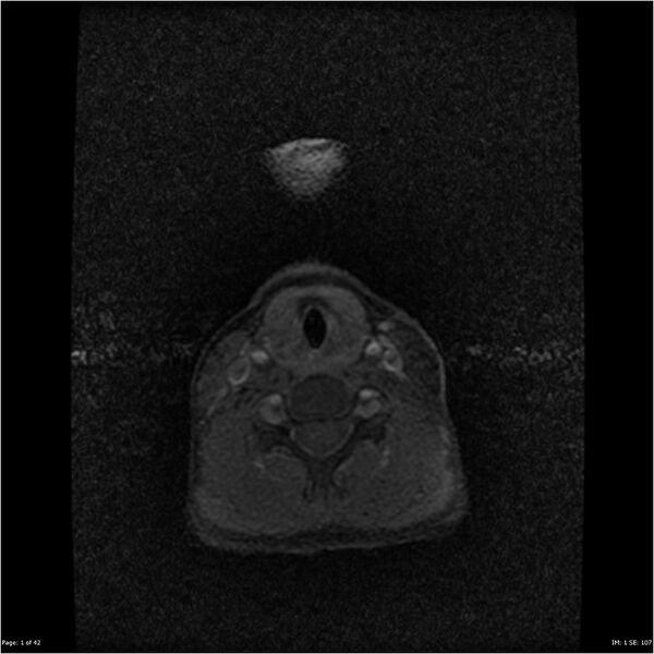 File:Neurofibromatosis type 1 (Radiopaedia 22541-22564 Axial T1 C+ fat sat 1).jpg