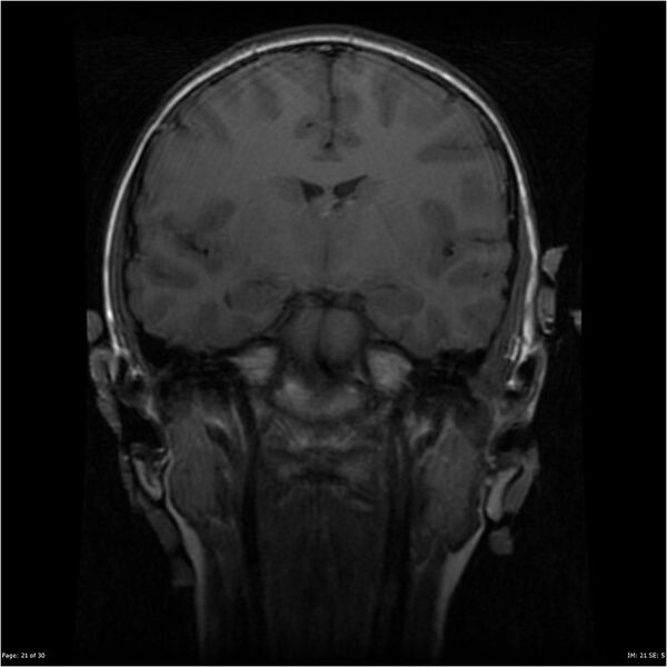 File:Neurofibromatosis type 1 (Radiopaedia 22541-22564 Coronal T1 30).jpg