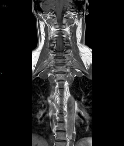 File:Neurofibromatosis type 1 (Radiopaedia 36933-38560 Coronal T1 11).jpg