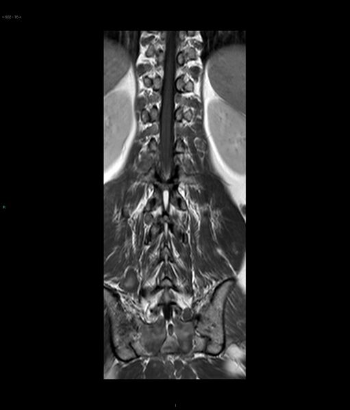 File:Neurofibromatosis type 1 (Radiopaedia 36933-38560 E 16).jpg