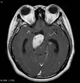 Neurofibromatosis type 2 - cranial and spinal involvement (Radiopaedia 5351-7111 Axial T1 C+ 9).jpg