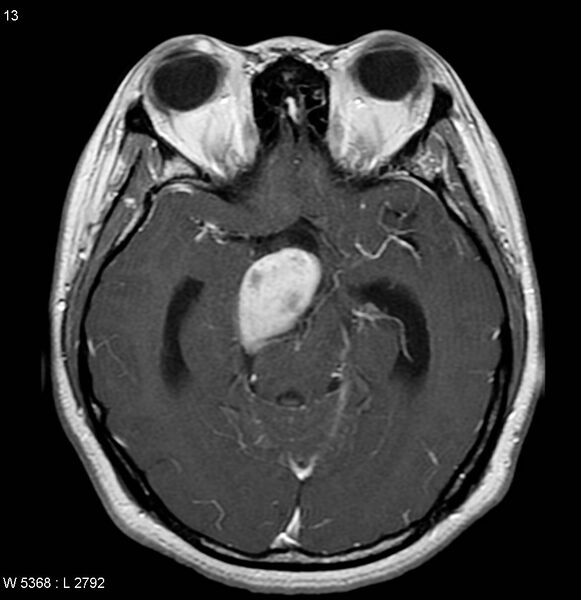 File:Neurofibromatosis type 2 - cranial and spinal involvement (Radiopaedia 5351-7111 Axial T1 C+ 9).jpg