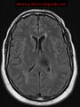 Neuroglial cyst (Radiopaedia 10713-11184 Axial FLAIR 10).jpg