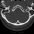 Normal CT of the cervical spine (Radiopaedia 53322-59305 Axial bone window 26).jpg