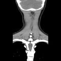 Normal CT of the neck (Radiopaedia 14575-14500 Coronal C+ 45).jpg