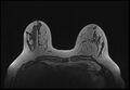 Normal breast MRI - dense breasts (Radiopaedia 80454-93850 Axial T1 72).jpg