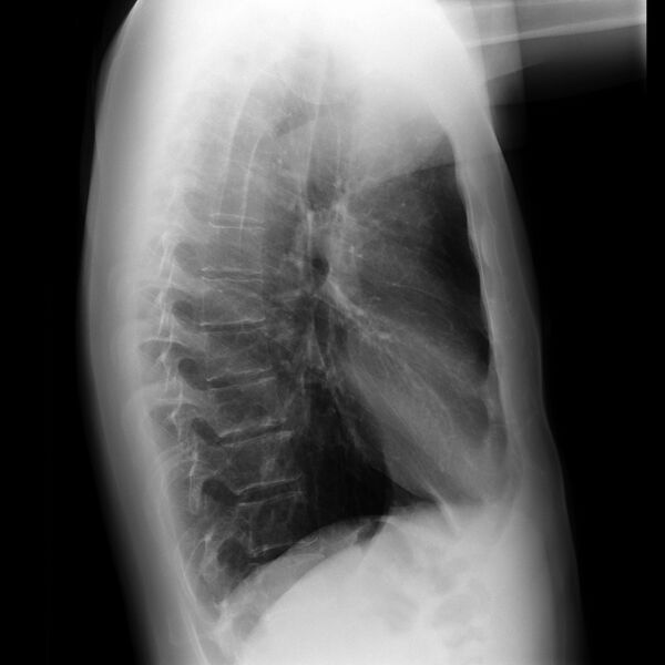 File:Normal chest x-ray (Radiopaedia 8304-9147 Lateral 1).jpg