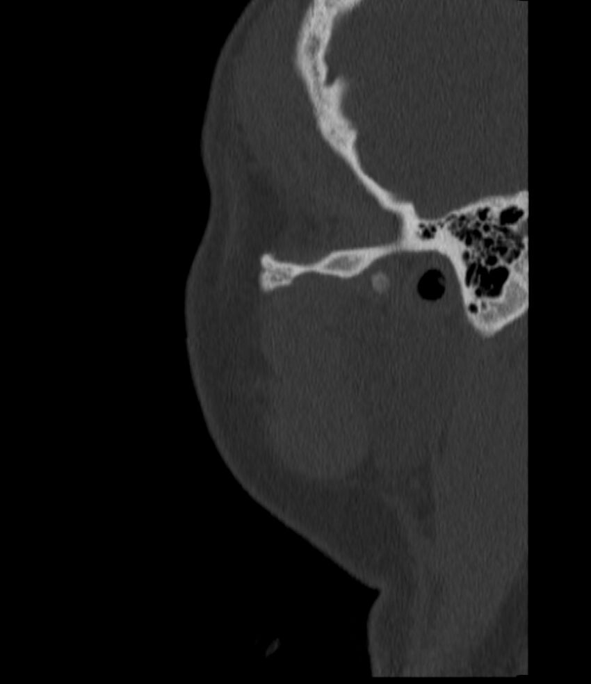 Normal facial bone CT (Radiopaedia 88742-105476 Sagittal bone window 149).jpg