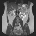 Normal liver MRI with Gadolinium (Radiopaedia 58913-66163 Coronal T2 22).jpg