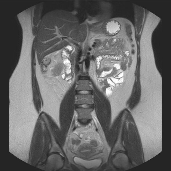 File:Normal liver MRI with Gadolinium (Radiopaedia 58913-66163 Coronal T2 22).jpg