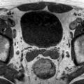 Normal prostate (MRI) (Radiopaedia 29986-30535 Axial T1 22).jpg