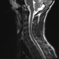 Normal trauma cervical spine (Radiopaedia 41017-43762 Sagittal T2 7).png