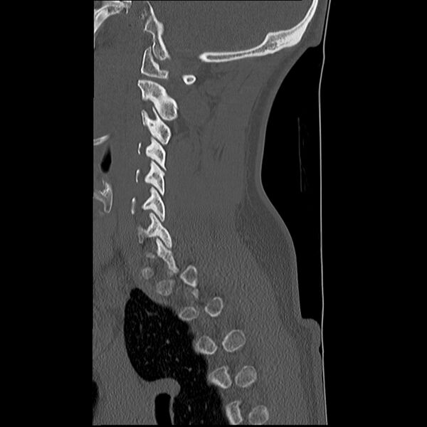 File:Normal trauma spine imaging (Radiopaedia 31753-32686 Sagittal bone window 12).jpg