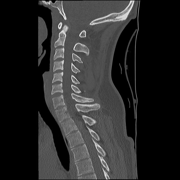 File:Normal trauma spine imaging (Radiopaedia 31753-32686 Sagittal bone window 21).jpg