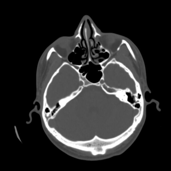File:Occipital spur - asymptomatic (Radiopaedia 87753-104201 Axial bone window 44).jpg