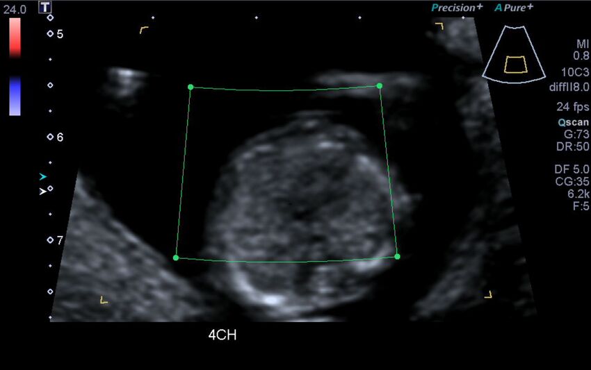 1st trimester nuchal-morphology ultrasound (Radiopaedia 44706-48477 Heart views cine with colour 55).jpg