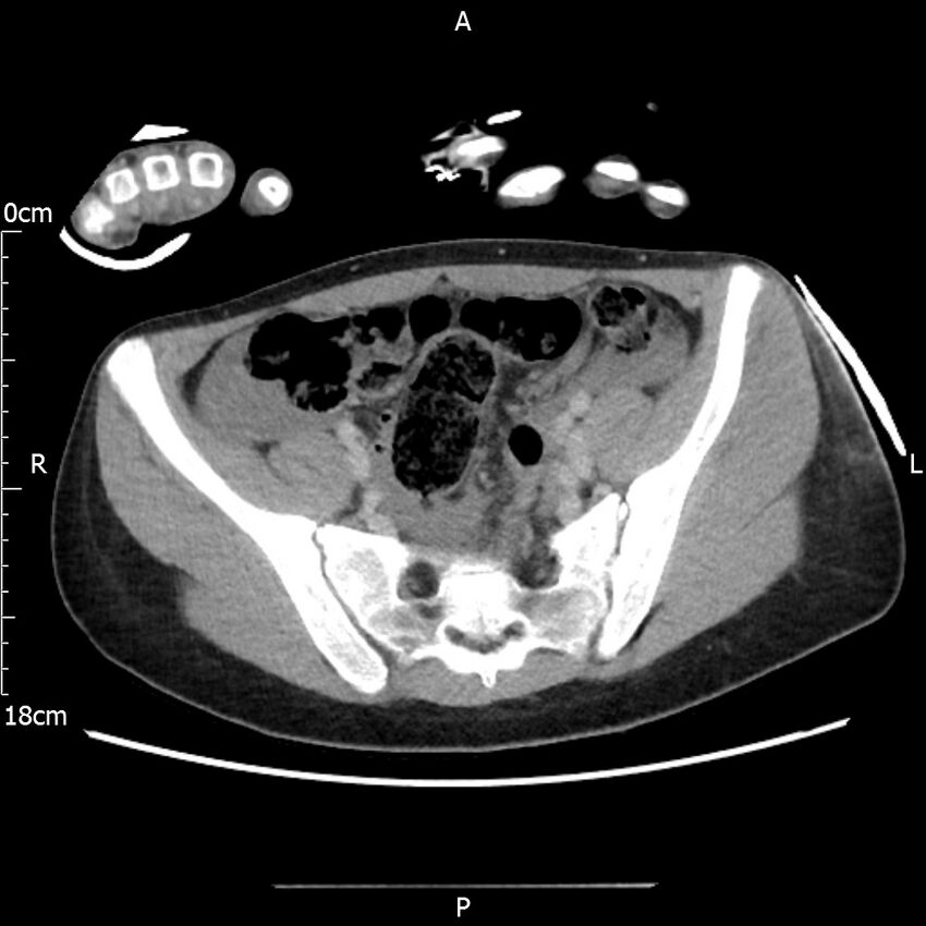 AAST grade IV kidney injury with CEUS follow-up (Radiopaedia 72353-82877 Axial C+ portal venous phase 58).jpg