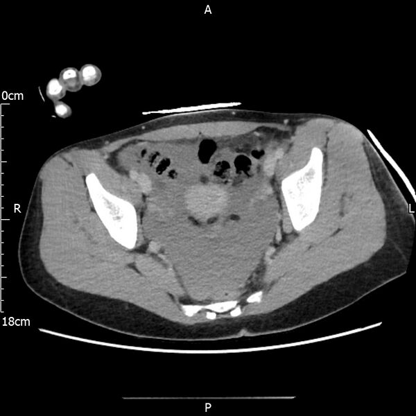 File:AAST grade IV kidney injury with CEUS follow-up (Radiopaedia 72353-82877 Axial C+ portal venous phase 67).jpg