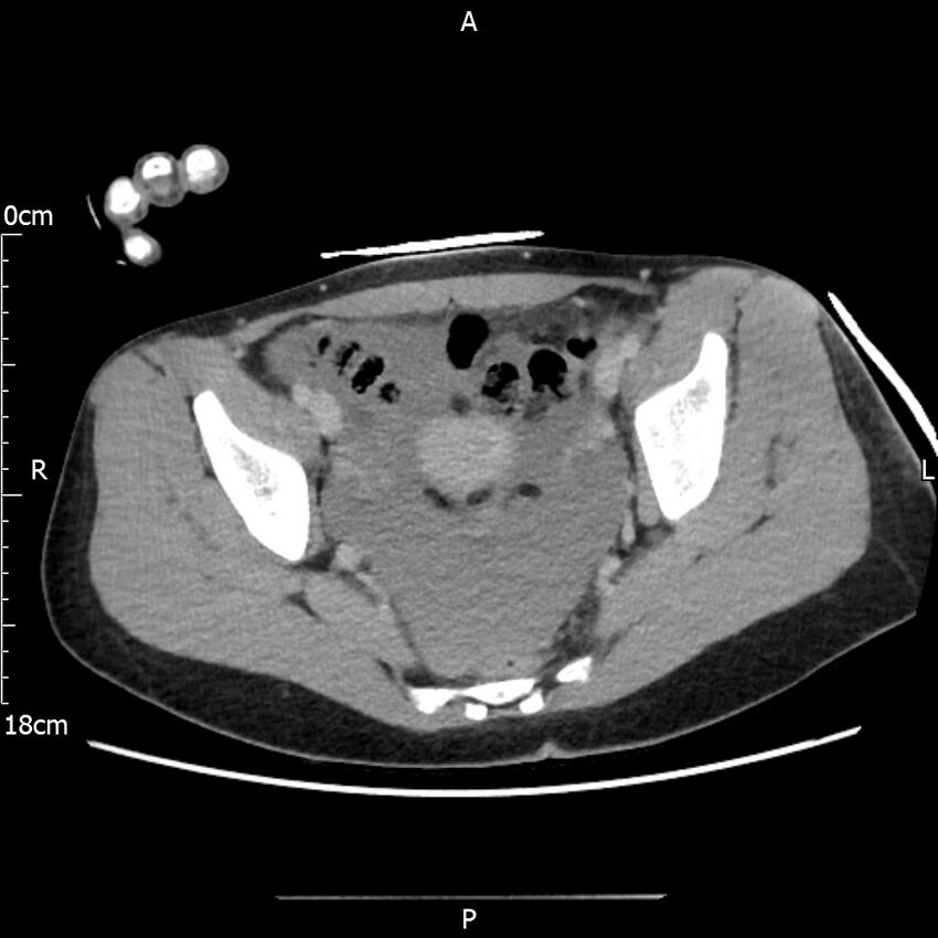 AAST grade IV kidney injury with CEUS follow-up (Radiopaedia 72353-82877 Axial C+ portal venous phase 67).jpg