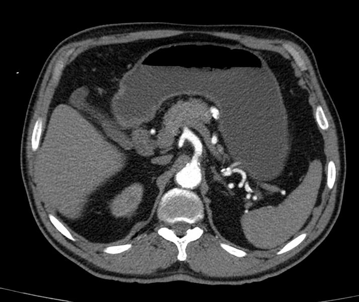 File:Abdominal aortic aneurysm (Radiopaedia 22421-22458 C+ arterial phase 15).jpg