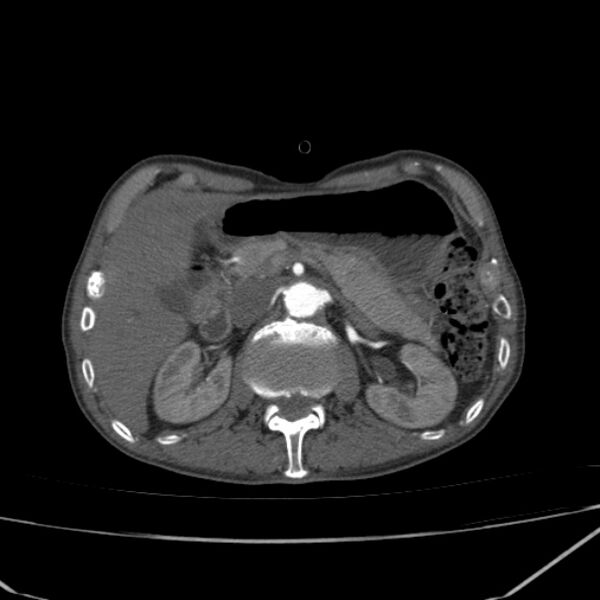 File:Abdominal aortic aneurysm (Radiopaedia 23703-23856 Axial C+ arterial phase 22).jpg