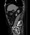 Abdominal aortic aneurysm (Radiopaedia 25855-26001 Sagittal C+ arterial phase 2).jpg