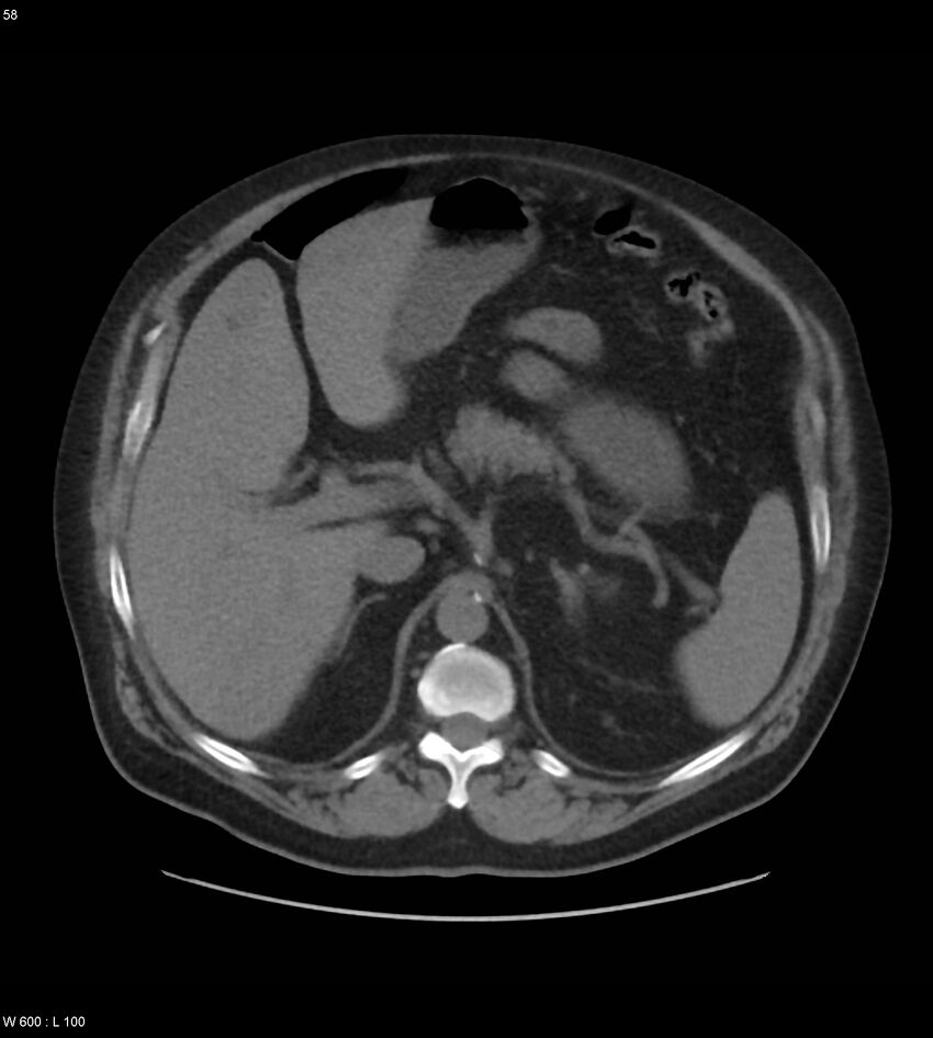Abdominal aortic aneurysm with intramural hematoma then rupture (Radiopaedia 50278-55631 Axial non-contrast 54).jpg