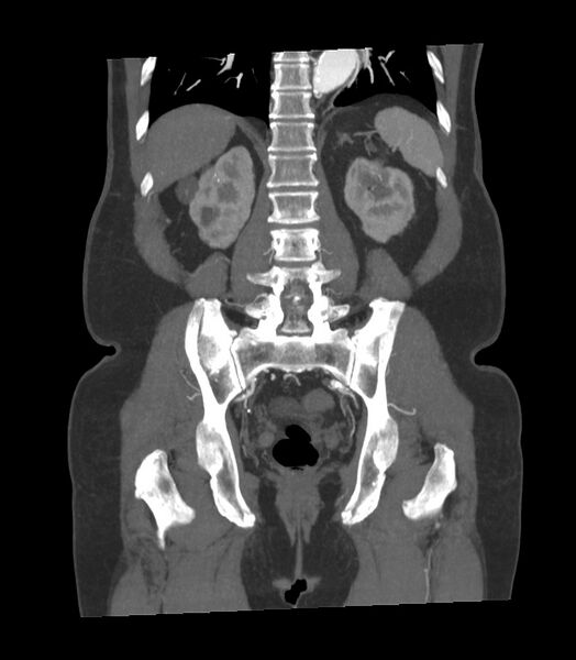 File:Abdominal aortic aneurysm with thrombus fissuration (Radiopaedia 46218-50618 Coronal C+ arterial phase 9).jpg