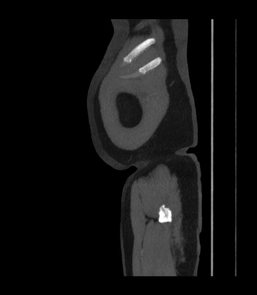 File:Abdominal aortic aneurysm with thrombus fissuration (Radiopaedia 46218-50618 Sagittal C+ arterial phase 1).jpg