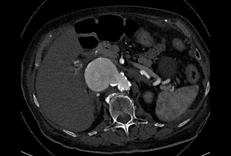 File:Abdominal aortic aneurysm with thrombus fissuration (Radiopaedia 73192-83919 Axial C+ arterial phase 41).jpg