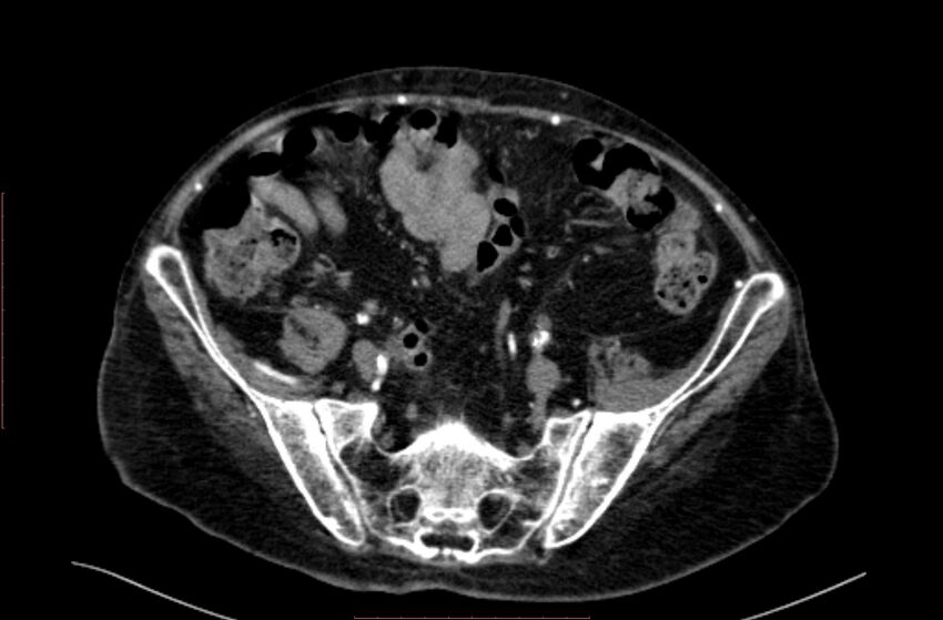 Abdominal aortic interposition tube graft and aneurysm thrombosis (Radiopaedia 71438-81857 Axial C+ arterial phase 164).jpg