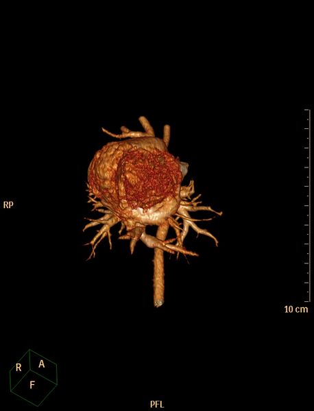 File:Aberrant left pulmonary artery (pulmonary sling) (Radiopaedia 42323-45435 3D reconstruction C+ CTPA 4).jpg