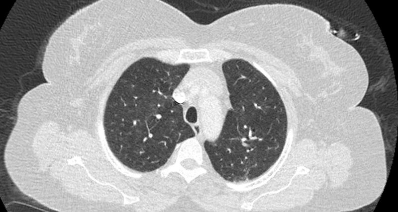 File:Accessory right inferior hepatic vein (Radiopaedia 65245-74259 Axial lung window 12).jpg
