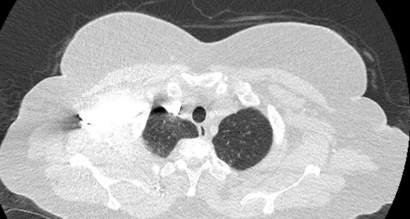 File:Accessory right inferior hepatic vein (Radiopaedia 65245-74259 Axial lung window 3).jpg