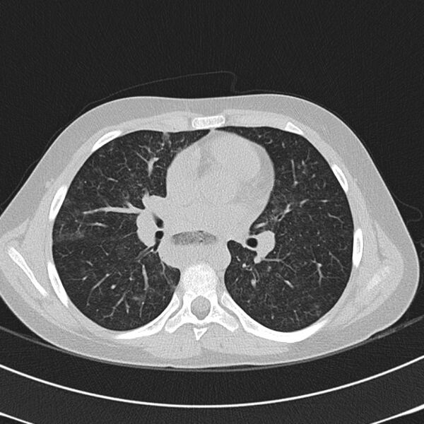 File:Achalasia (Radiopaedia 14946-14878 Axial lung window 38).jpg