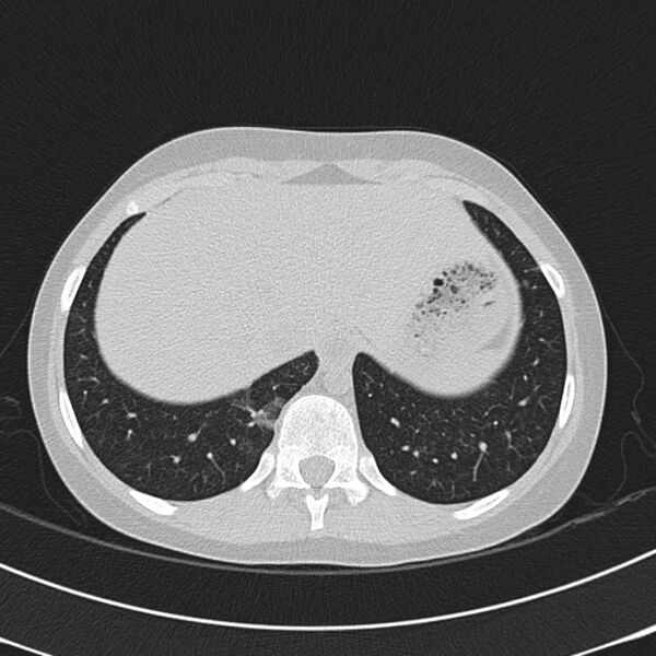 File:Achalasia (Radiopaedia 14946-14878 Axial lung window 70).jpg