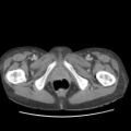 Actinomycosis related to longstanding IUD (Radiopaedia 77303-89380 Axial C+ portal venous phase 87).jpg