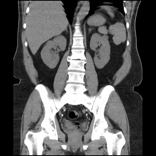 File:Active colonic bleed on CT (Radiopaedia 49765-55025 Coronal non-contrast 36).jpg