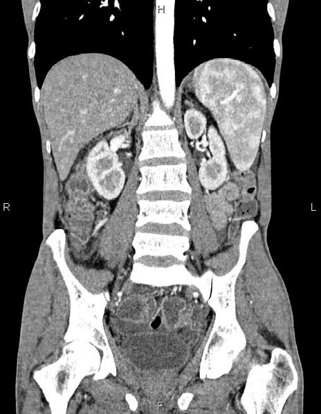 File:Active crohn disease (Radiopaedia 87133-103397 Coronal C+ arterial phase 41).jpg