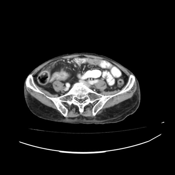 File:Acute-on-chronic Crohn disease with enteroenteric fistula (Radiopaedia 66686-75987 B 37).jpg