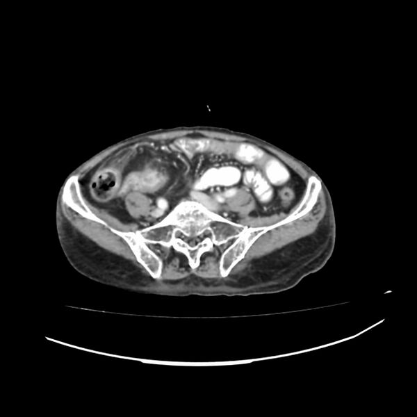 File:Acute-on-chronic Crohn disease with enteroenteric fistula (Radiopaedia 66686-75987 B 38).jpg