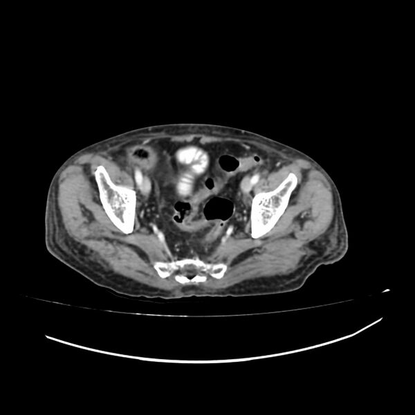 File:Acute-on-chronic Crohn disease with enteroenteric fistula (Radiopaedia 66686-75987 B 67).jpg