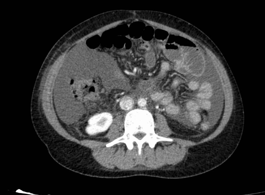 Acute Budd-Chiari syndrome (Radiopaedia 60858-68638 Axial C+ portal venous phase 163).jpg