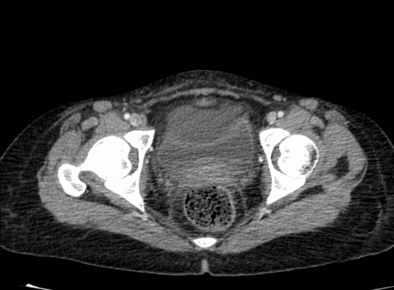 File:Acute Budd-Chiari syndrome (Radiopaedia 60858-68638 Axial C+ portal venous phase 283).jpg