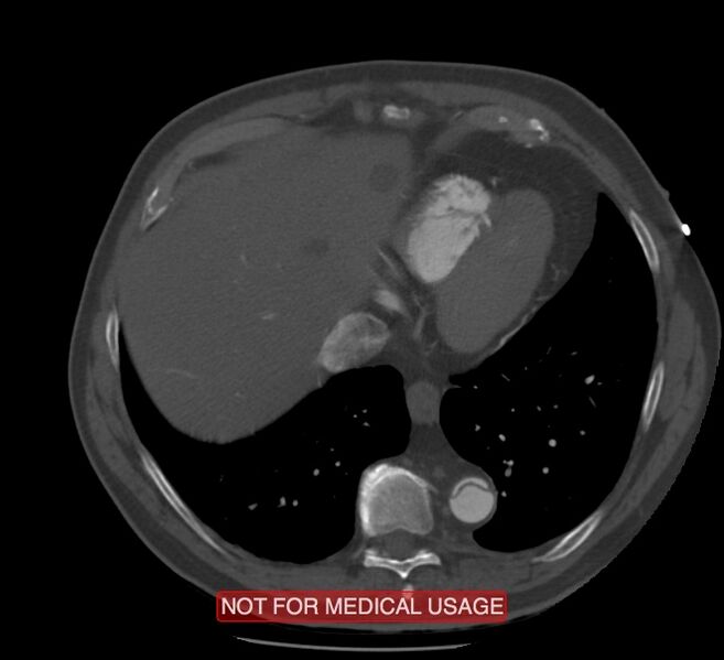 File:Acute aortic dissection - Stanford type A (Radiopaedia 40661-43285 Axial C+ arterial phase 58).jpg