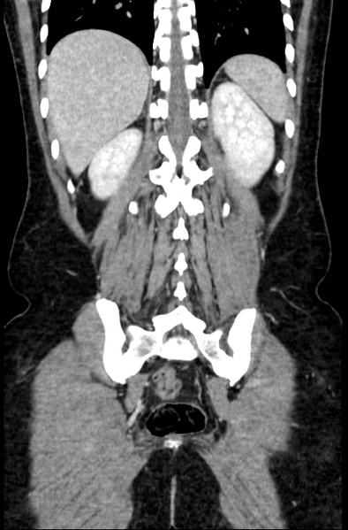 File:Acute appendicitis (Radiopaedia 22892-22918 Coronal C+ portal venous phase 46).png