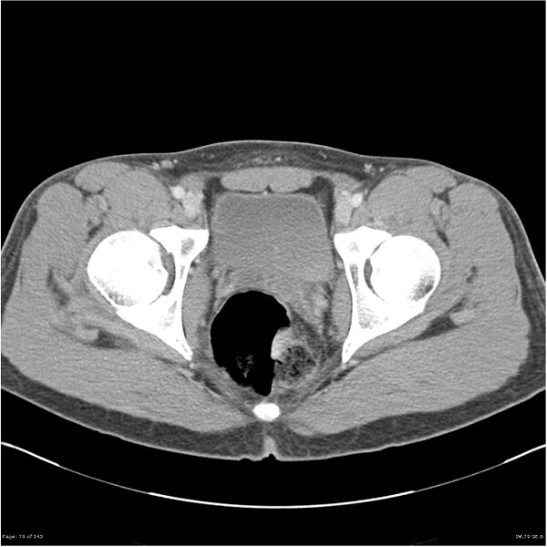 File:Acute appendicitis (Radiopaedia 25364-25615 B 69).jpg